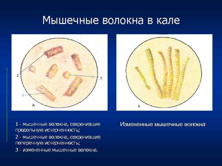 Растительная клетчатка в кале. Микроскопия кала мышечные волокна. Наличие в Кале непереваренных мышечных волокон это. Непереваренные мышечные волокна в Кале. Мышечные волокна с исчерченностью в Кале.