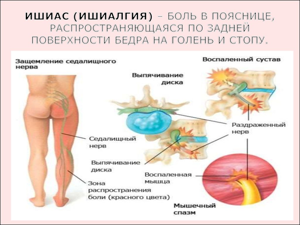 Седалищный нерв симптомы у женщин как болит чем лечить фото