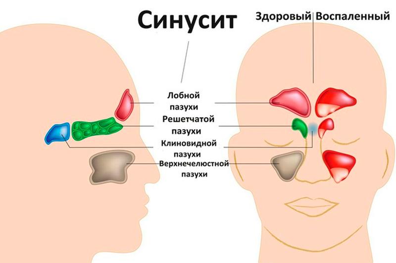 Гастроэзофагеальная рефлюксная болезнь: новый подход к причинам и лечению * клиника диана в санкт-петербурге