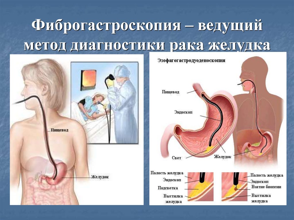 Схема диагностических мероприятий при наличии опухоли в желудке