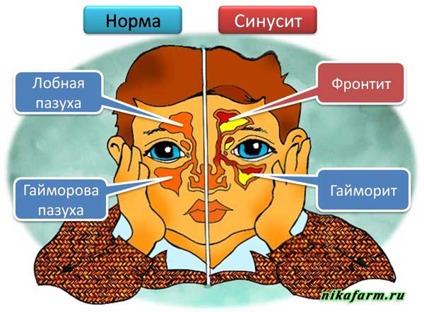 Полинейропатия