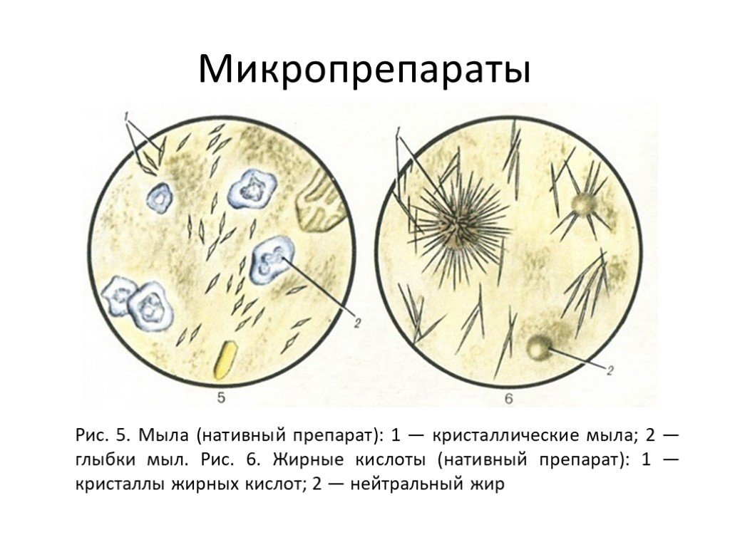 Жирные кислоты в кале. Микроскопия кала атлас копрология. Микроскопия кала мышечные волокна. Кристаллы жирных кислот микроскопия кала. Микроскопия кала нативный препарат.